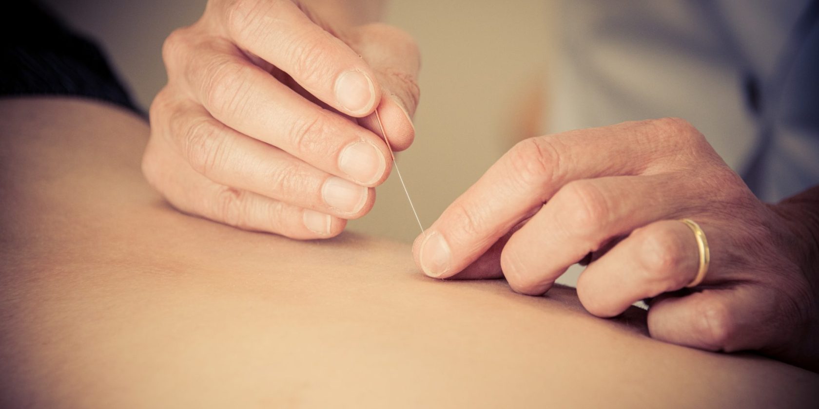 acupunctuur en burn out